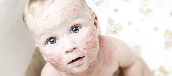 About Atopic Dermatitis (AD)