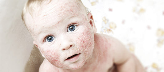 About Atopic Dermatitis (AD)