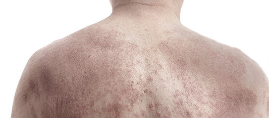 About Seborrheic Dermatitis