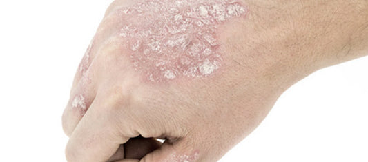 About Psoriasis