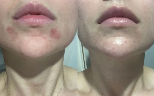 Sensitive Skin Barrier Care Bundle