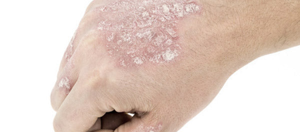 About Psoriasis